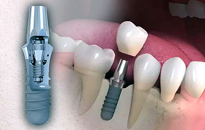 Implantes Dentales Straumann® | Clínica Rostirolla